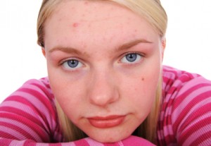 Acne: Supplements to Help