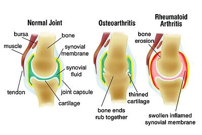 Inflammatory Arthritis