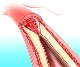 Arteries_clogging