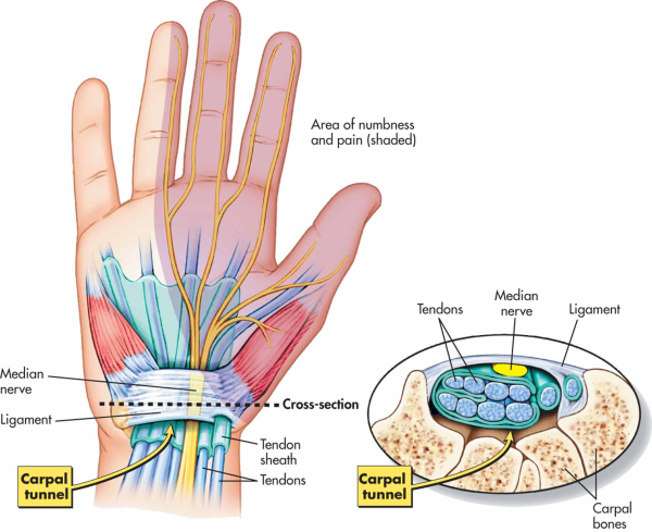 Effective Carpal Tunnel Treatment